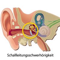 Schematische Abbildung eines Ohrs, mit Markierung beim Gehörgang