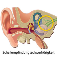 Schematische Abbildung eines Ohrs, mit Markierung beim Innenohr
